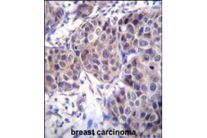 DVL3 Antibody immunohistochemistry analysis in formalin fixed and paraffin embedded human breast carcinoma followed by peroxidase conjugation of the secondary antibody and DAB staining.