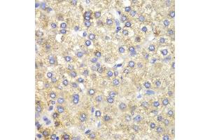 Immunohistochemistry of paraffin-embedded human liver cancer using HADH antibody (ABIN5970434) at dilution of 1/100 (40x lens). (HADH anticorps)