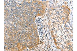 The image on the left is immunohistochemistry of paraffin-embedded Human cervical cancer tissue using ABIN7128369(ALPI Antibody) at dilution 1/25, on the right is treated with fusion protein.