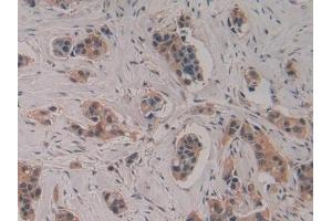 Detection of CASP4 in Human Breast cancer Tissue using Polyclonal Antibody to Caspase 4 (CASP4)