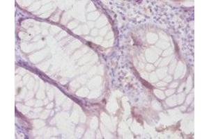 Immunohistochemistry of paraffin-embedded human colon cancer using ABIN7159497 at dilution of 1:100 (TIMP4 anticorps  (AA 31-224))