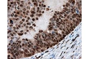 Immunohistochemical staining of paraffin-embedded Adenocarcinoma of breast tissue using anti-LTA4H mouse monoclonal antibody. (LTA4H anticorps)