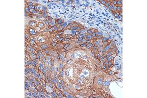 Immunohistochemistry of paraffin-embedded human esophageal cancer using BCL2L12 Rabbit mAb (ABIN7265864) at dilution of 1:100 (40x lens). (BCL2L12 anticorps)
