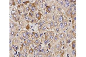 Immunohistochemistry of paraffin-embedded Human liver cancer using GAS2 Polyclonal Antibody at dilution of 1:200 (40x lens). (GAS2 anticorps)