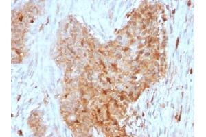 Formalin-fixed, paraffin-embedded human Breast Carcinoma stained with GPI Mouse Monoclonal Antibody (CPTC-GPI-1). (GPI anticorps)