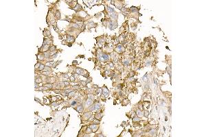 Immunohistochemistry of paraffin-embedded human lung cancer using Na+/K+-ATPase Rabbit pAb (ABIN6133568, ABIN6137299, ABIN6137301 and ABIN6223860) at dilution of 1:50 (40x lens).