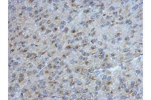 IHC-P Image Immunohistochemical analysis of paraffin-embedded U87 xenograft, using UGCGL2, antibody at 1:500 dilution. (UGCGL2 anticorps)