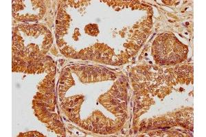 IHC image of ABIN7140147 diluted at 1:100 and staining in paraffin-embedded human prostate cancer performed on a Leica BondTM system.