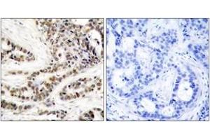 Immunohistochemistry analysis of paraffin-embedded human breast carcinoma, using CREB (Phospho-Ser129) Antibody. (CREB1 anticorps  (pSer129))