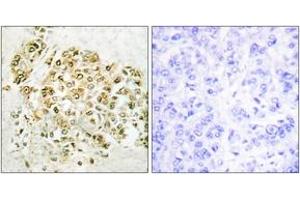 Immunohistochemistry analysis of paraffin-embedded human breast carcinoma tissue, using MZF-1 Antibody. (MZF1 anticorps  (AA 1-50))