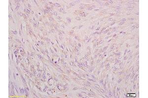 Formalin-fixed and paraffin embedded human cervical carcinoma tissue labeled with Anti CIP2A/p90 Autoantigen Polyclonal Antibody,Unconjugated (ABIN760241) at 1:200 followed by conjugation to the secondary antibody and DAB staining. (KIAA1524 anticorps  (AA 601-700))