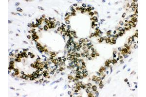 Anti- Lamin B1 Picoband antibody, IHC(P) IHC(P): Human Mammary Cancer Tissue (Lamin B1 anticorps  (AA 266-583))
