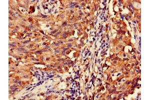 Immunohistochemistry of paraffin-embedded human lung cancer using ABIN7159021 at dilution of 1:100 (MAS1L anticorps  (AA 318-378))