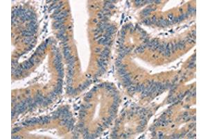 The image on the left is immunohistochemistry of paraffin-embedded Human colon cancer tissue using ABIN7190351(CRIM1 Antibody) at dilution 1/25, on the right is treated with synthetic peptide. (CRIM1 anticorps)