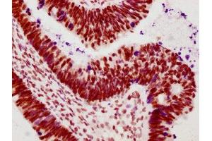 IHC image of ABIN7127725 diluted at 1:100 and staining in paraffin-embedded human ovarian cancer performed on a Leica BondTM system.