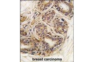 Formalin-fixed and paraffin-embedded human breast carcinoma tissue reacted with CASC3 Antibody  (ABIN391402 and ABIN2837845) , which was peroxidase-conjugated to the secondary antibody, followed by DAB staining.