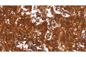 Immunohistochemistry of paraffin-embedded Human gasrtic cancer tissue using HCAR2 Polyclonal Antibody at dilution 1:40