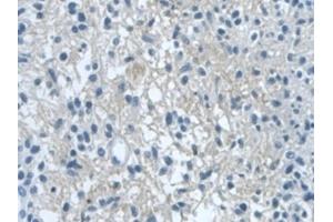 Detection of DVL1 in Human Glioma Tissue using Polyclonal Antibody to Dishevelled, Dsh Homolog 1 (DVL1)