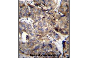TM4SF1 Antibody (N-term) (ABIN656640 and ABIN2845885) immunohistochemistry analysis in formalin fixed and paraffin embedded human breast carcinoma followed by peroxidase conjugation of the secondary antibody and DAB staining.