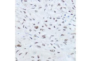 Immunohistochemistry of paraffin-embedded human esophageal cancer using SRRM1 Rabbit pAb (ABIN6133184, ABIN6148463, ABIN6148464 and ABIN6221692) at dilution of 1:450 (40x lens). (SRRM1 anticorps  (AA 1-160))