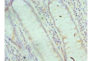 Immunohistochemistry of paraffin-embedded human colon cancer using ABIN7153696 at dilution of 1:100