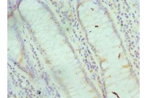 Immunohistochemistry of paraffin-embedded human colon cancer using ABIN7153696 at dilution of 1:100 (FABP6 anticorps  (AA 1-128))