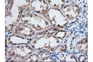 Immunohistochemical staining of paraffin-embedded Adenocarcinoma of Human ovary tissue using anti-IGF2BP2 mouse monoclonal antibody. (IGF2BP2 anticorps)