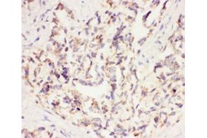 IHC-P: VEGF antibody testing of human lung cancer tissue (VEGFA anticorps  (AA 27-191))
