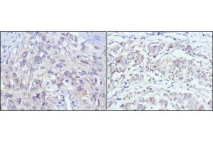 Immunohistochemical analysis of paraffin-embedded human lung cancer (left) and gastric cancer (right) using PAK2 mouse mAb with DAB staining. (PAK2 anticorps)