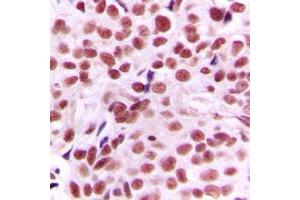 Immunohistochemical analysis of c-Myc staining in human breast cancer formalin fixed paraffin embedded tissue section. (c-MYC anticorps  (N-Term))