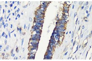 Immunohistochemistry of paraffin-embedded Human uterine cancer using FKBP1A Polyclonal Antibody at dilution of 1:200 (40x lens). (FKBP1A anticorps)
