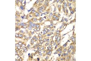 Immunohistochemistry of paraffin-embedded human esophageal cancer using VTI1B antibody (ABIN6132781, ABIN6150162, ABIN6150163 and ABIN6222854) at dilution of 1:100 (40x lens). (VTI1B anticorps  (AA 1-210))