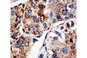 IHC analysis of FFPE human hepatocarcinoma tissue stained with the KMT4 antibody (DOT1L anticorps  (AA 1390-1420))