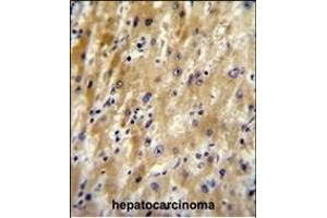 HABP2 Antibody (C-term) (ABIN651853 and ABIN2840423) immunohistochemistry analysis in formalin fixed and paraffin embedded human hepatocarcinoma followed by peroxidase conjugation of the secondary antibody and DAB staining. (HABP2 anticorps  (C-Term))