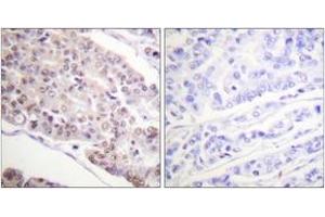 Immunohistochemistry analysis of paraffin-embedded human breast carcinoma tissue, using Histone H4 (Acetyl-Lys8) Antibody. (Histone H4 anticorps  (acLys8))