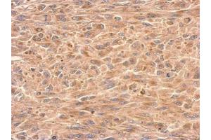 IHC-P Image GDI1 antibody detects GDI1 protein at cytosol on U87 xenograft by immunohistochemical analysis. (GDI1 anticorps)