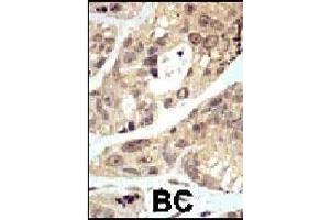 Formalin-fixed and paraffin-embedded human cancer tissue reacted with the primary antibody, which was peroxidase-conjugated to the secondary antibody, followed by DAB staining. (SUMO1 anticorps  (N-Term))