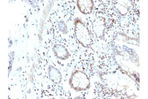 Formalin-fixed, paraffin-embedded human Colon Carcinoma stained with RAD51 Mouse Monoclonal Antibody (RAD51/2702). (RAD51 anticorps  (AA 1-134))