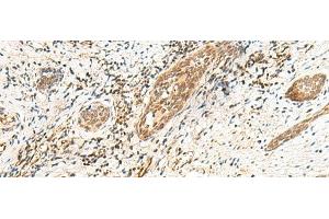 Immunohistochemistry of paraffin-embedded Human esophagus cancer tissue using POLR1D Polyclonal Antibody at dilution of 1:50(x200) (POLR1D anticorps)
