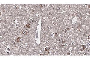 ABIN6277649 at 1/100 staining Human brain cancer tissue by IHC-P.