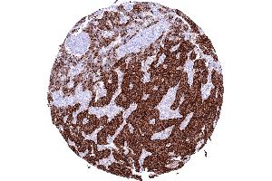 Pancreatic neuroendocrine tumor insulinoma with strong Insulin positivity of most tumor cells (Recombinant Insulin anticorps)