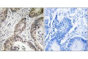 Immunohistochemistry analysis of paraffin-embedded human colon carcinoma, using TUT1 Antibody. (TUT1 anticorps  (AA 291-340))