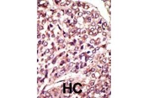 Formalin-fixed and paraffin-embedded human cancer tissue reacted with the primary antibody, which was peroxidase-conjugated to the secondary antibody, followed by AEC staining.