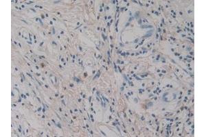 Detection of IL12A in Human Pancreatic cancer Tissue using Monoclonal Antibody to Interleukin 12A (IL12A) (IL12A anticorps  (AA 23-219))