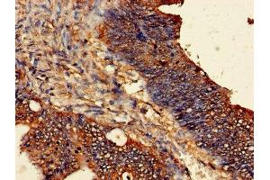 Immunohistochemistry of paraffin-embedded human colon cancer using ABIN7162297 at dilution of 1:100 (ODC1 anticorps  (AA 1-461))