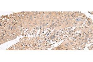 Immunohistochemistry of paraffin-embedded Human cervical cancer tissue using PATJ Polyclonal Antibody at dilution of 1:45(x200) (PATJ anticorps)
