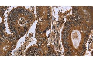 Immunohistochemistry of paraffin-embedded Human colon cancer using FGFRL1 Polyclonal Antibody at dilution of 1:40