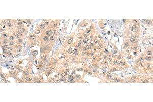 Immunohistochemistry of paraffin-embedded Human esophagus cancer tissue using HIPK2 Polyclonal Antibody at dilution of 1:40(x200) (HIPK2 anticorps)