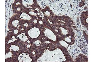 Immunohistochemical staining of paraffin-embedded Adenocarcinoma of Human colon tissue using anti-PDRG1 mouse monoclonal antibody. (PDRG1 anticorps)