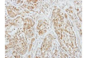 IHC-P Image Immunohistochemical analysis of paraffin-embedded A549 xenograft, using Factor X, antibody at 1:500 dilution. (Coagulation Factor X anticorps)